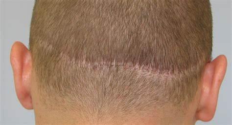 FUE vs. FUT