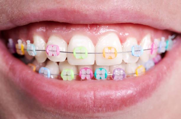 Putting the braces on
