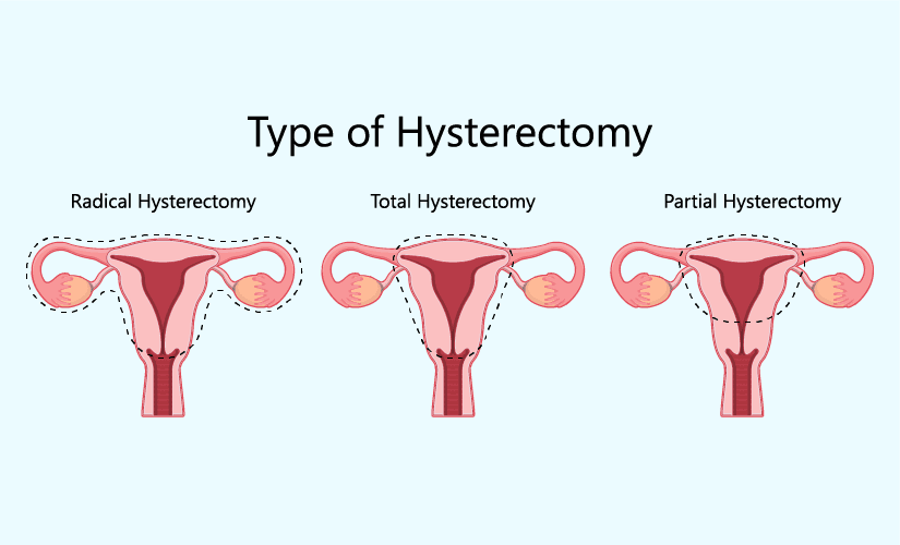 Hysterectomy