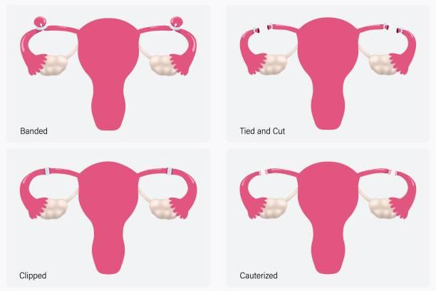 What is post-tubal ligation syndrome?