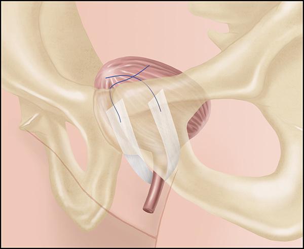 Urethral surgery recovery