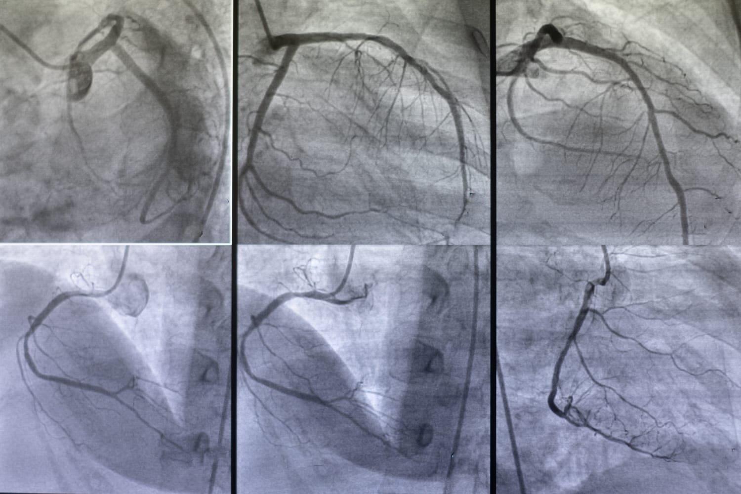 How is Angiography performed?