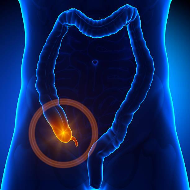 What is an Appendectomy?