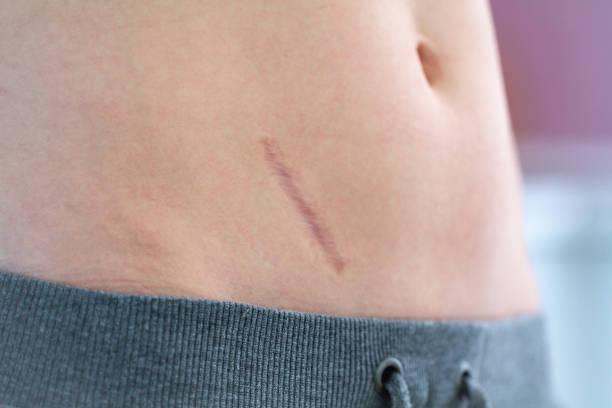 What are the risks of Appendectomy?
