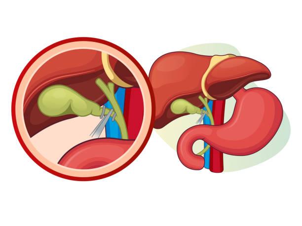 Cholecystectomy cost in Iran