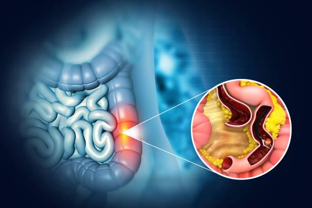 Colectomy benefits