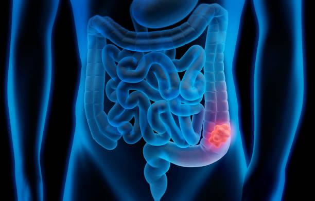 Colectomy recovery