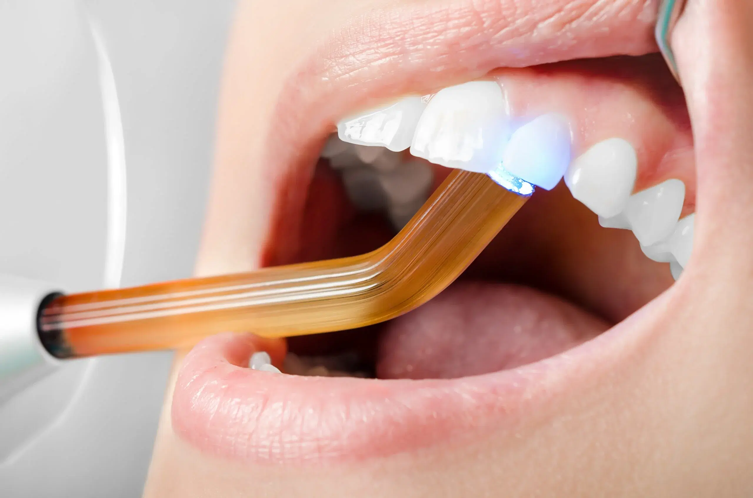 What Is Teeth Bonding?