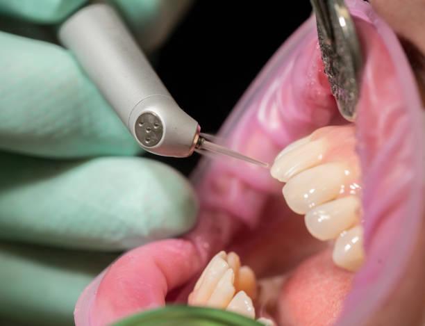 Teeth Bonding Benefits and Risks
