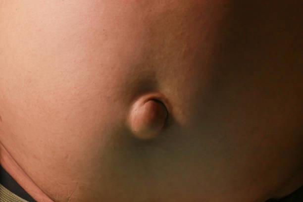Hernia Repair cost in Iran