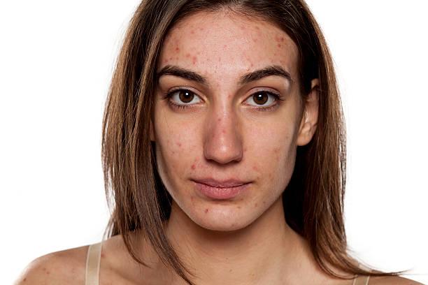 What is Acne?