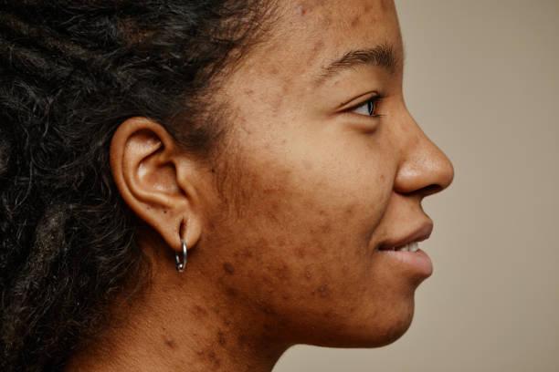 Acne Treatment cost in Iran