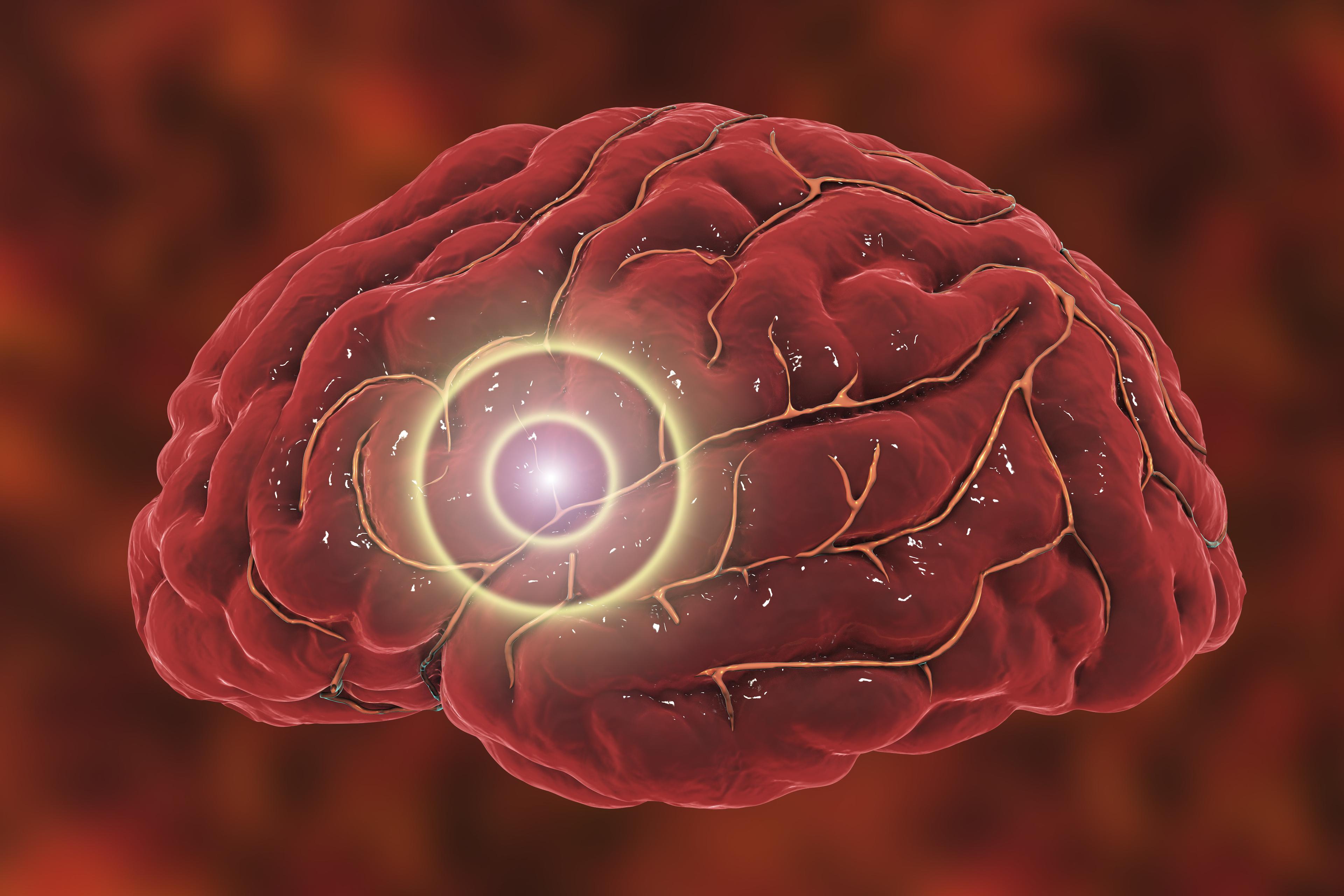 What blood vessels do cerebrovascular diseases affect?