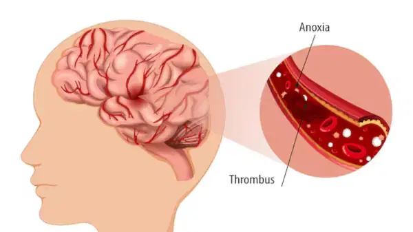 How is cerebrovascular disease treated?
