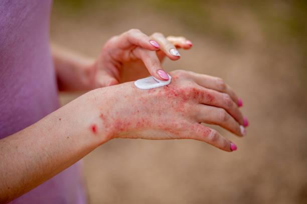 What is eczema?