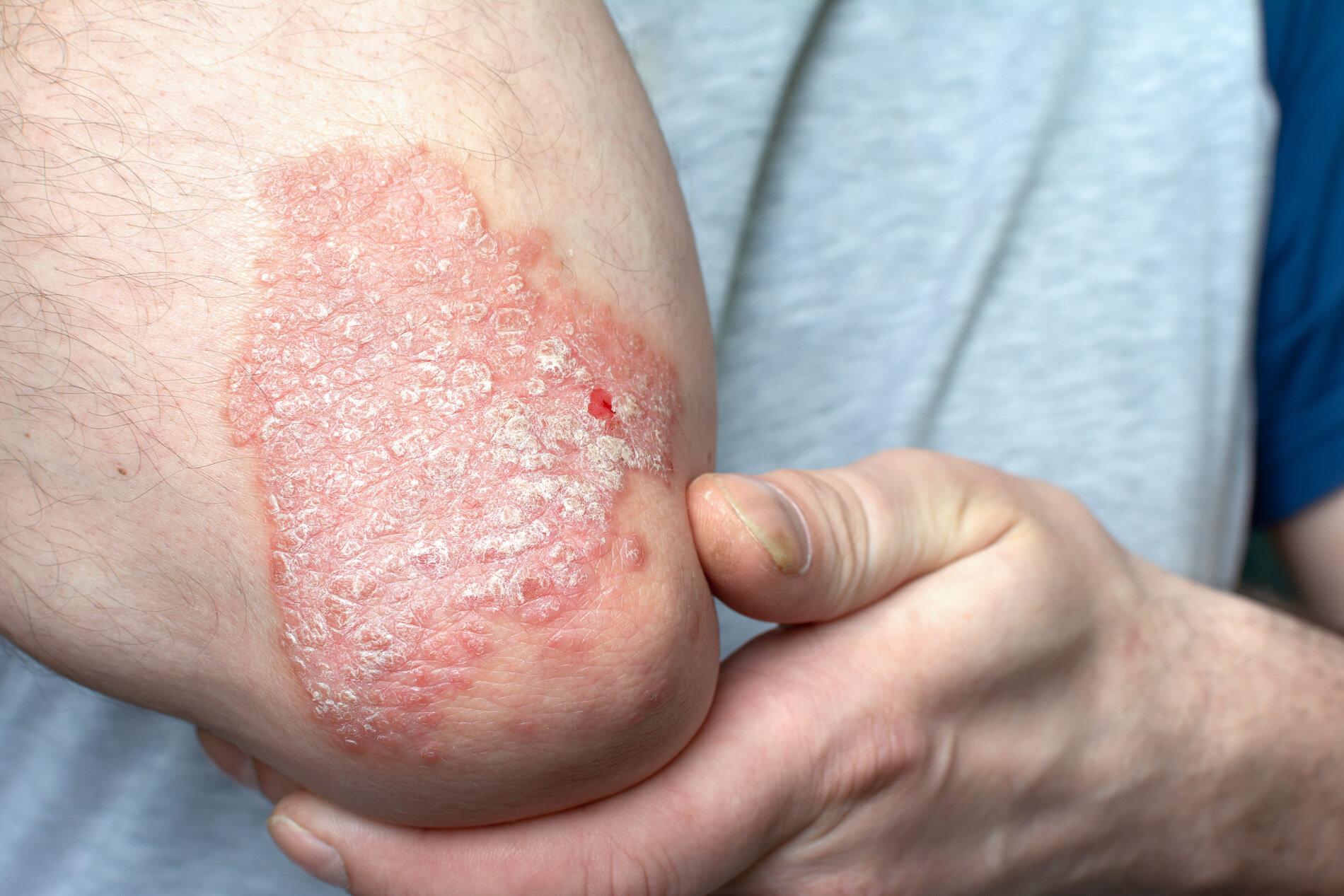 What causes psoriasis?