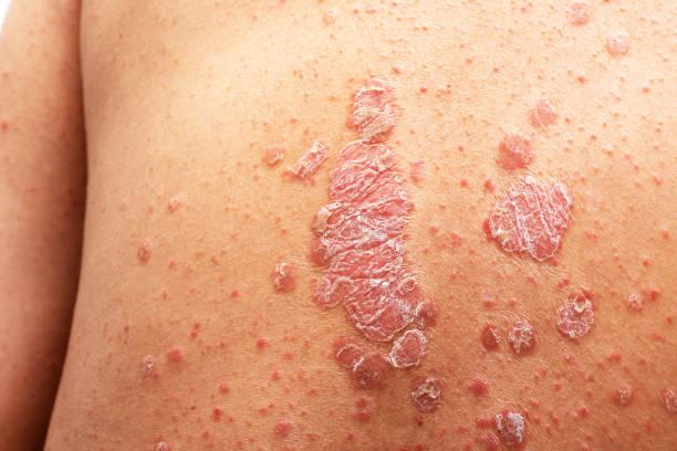 How is psoriasis diagnosed?