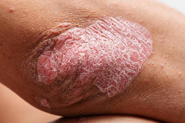 How is psoriasis treated?