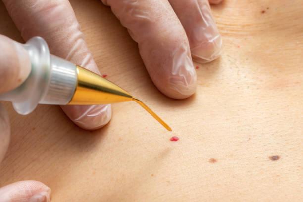 What are the types of Warts?