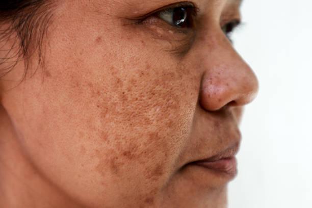 What are the signs of melasma?