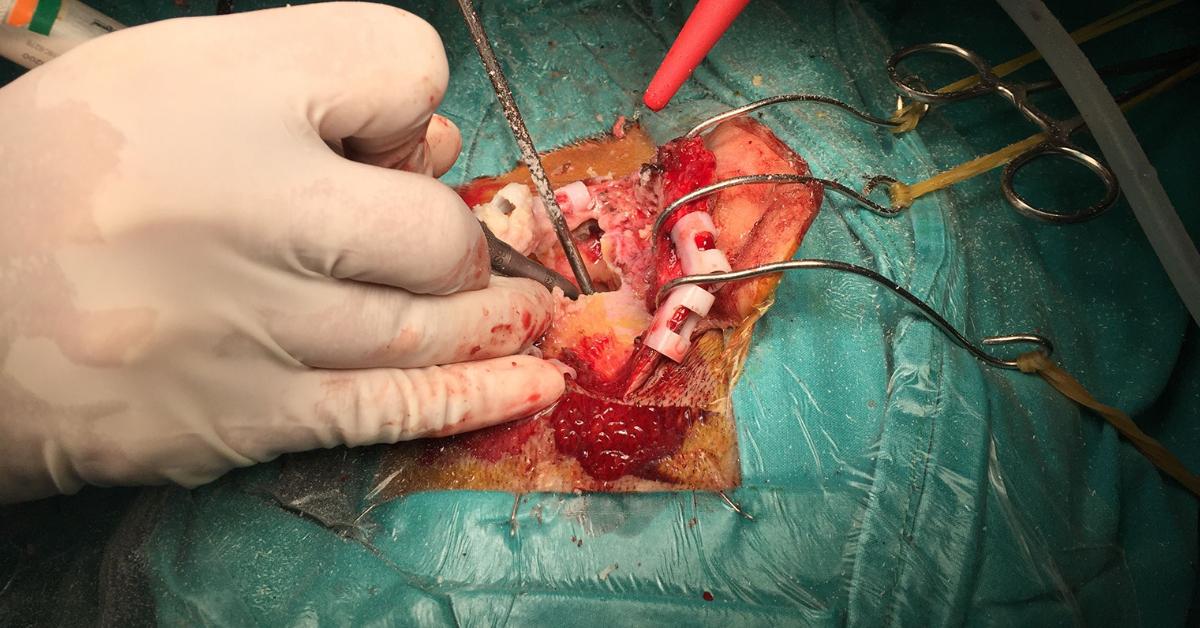 What is a mastoidectomy?