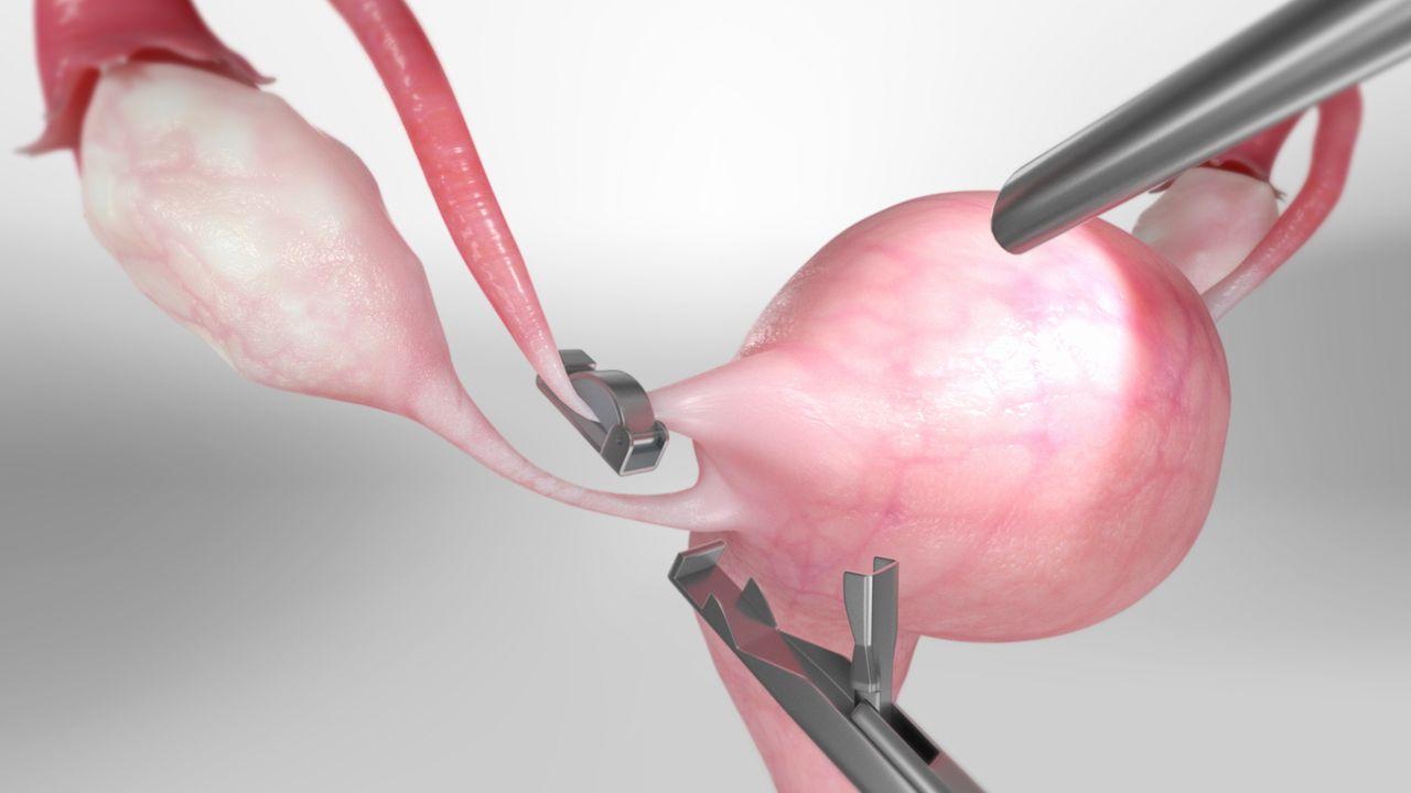 What is female sterilization?