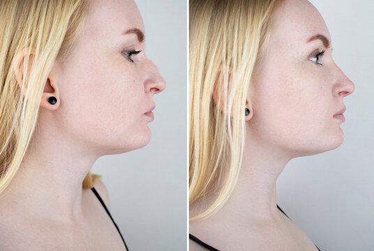 Septoplasty cost in Iran 