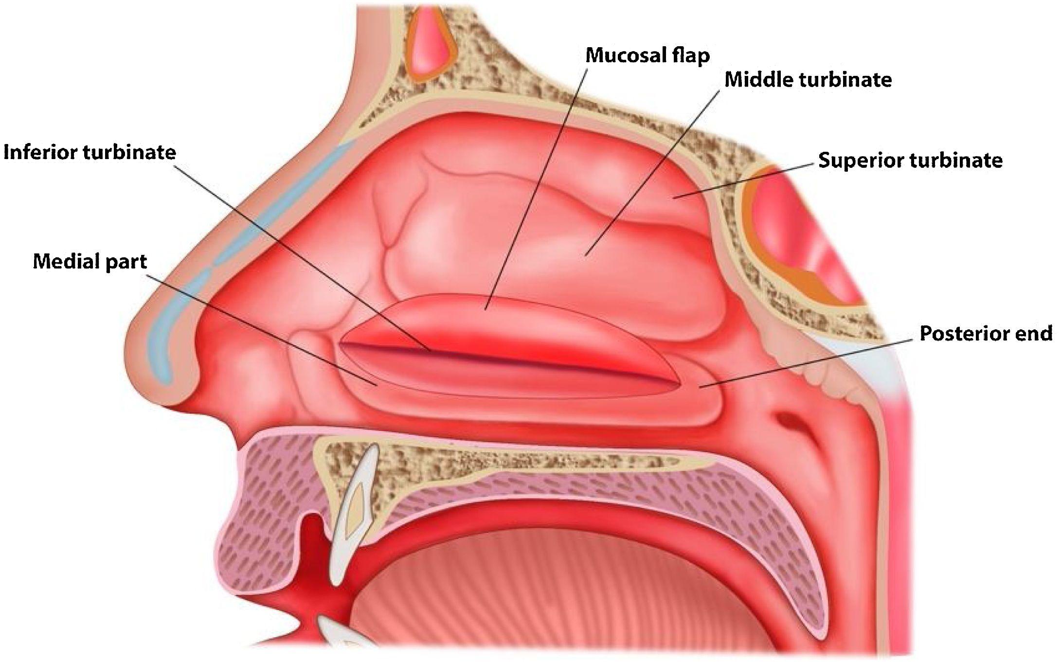 Why is Turbinoplasty done?