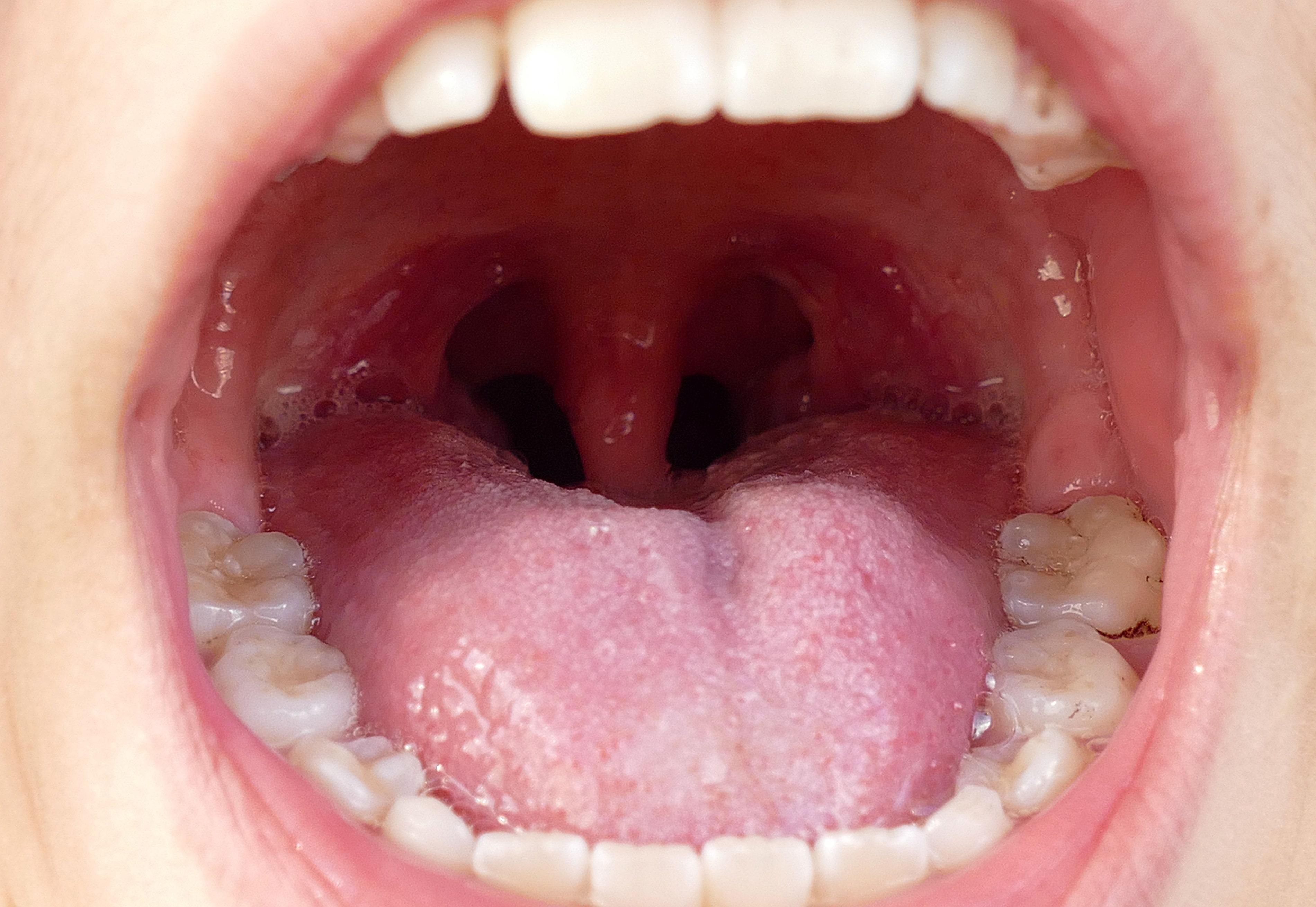 Tonsillectomy cost in Iran