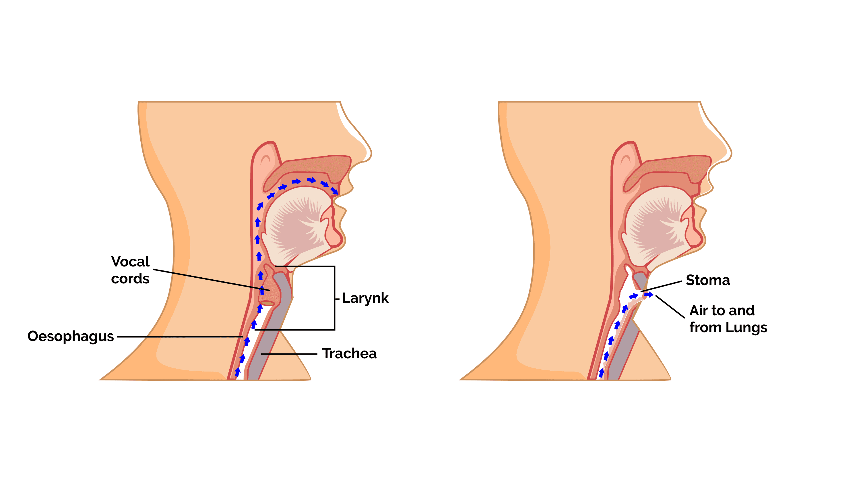What happens before laryngectomy surgery?