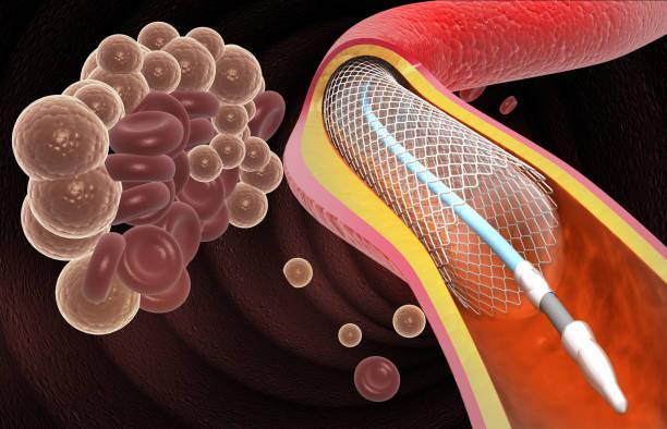 Why is Angioplasty Needed? 