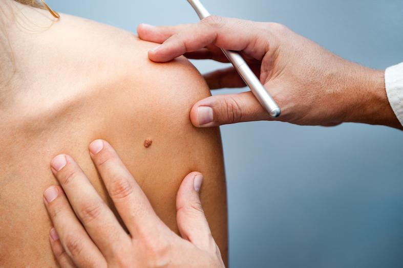 Mole Removal 