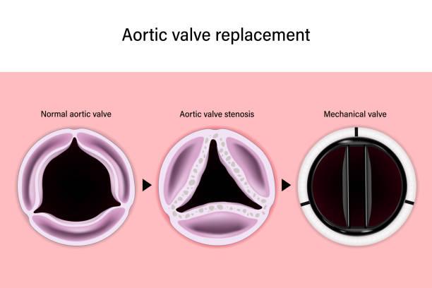 Why would I need a valve replacement?