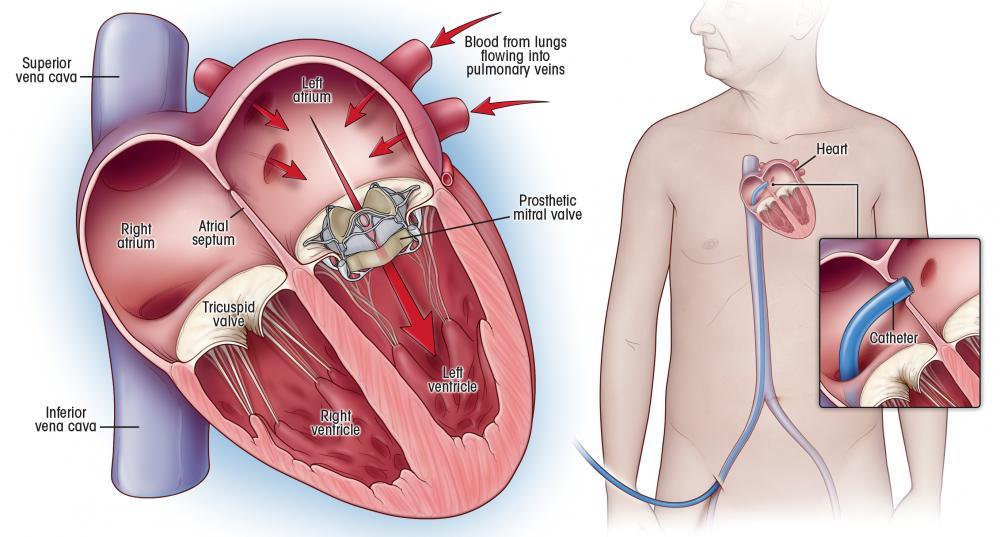 When is Aortic valve replacement surgery needed?