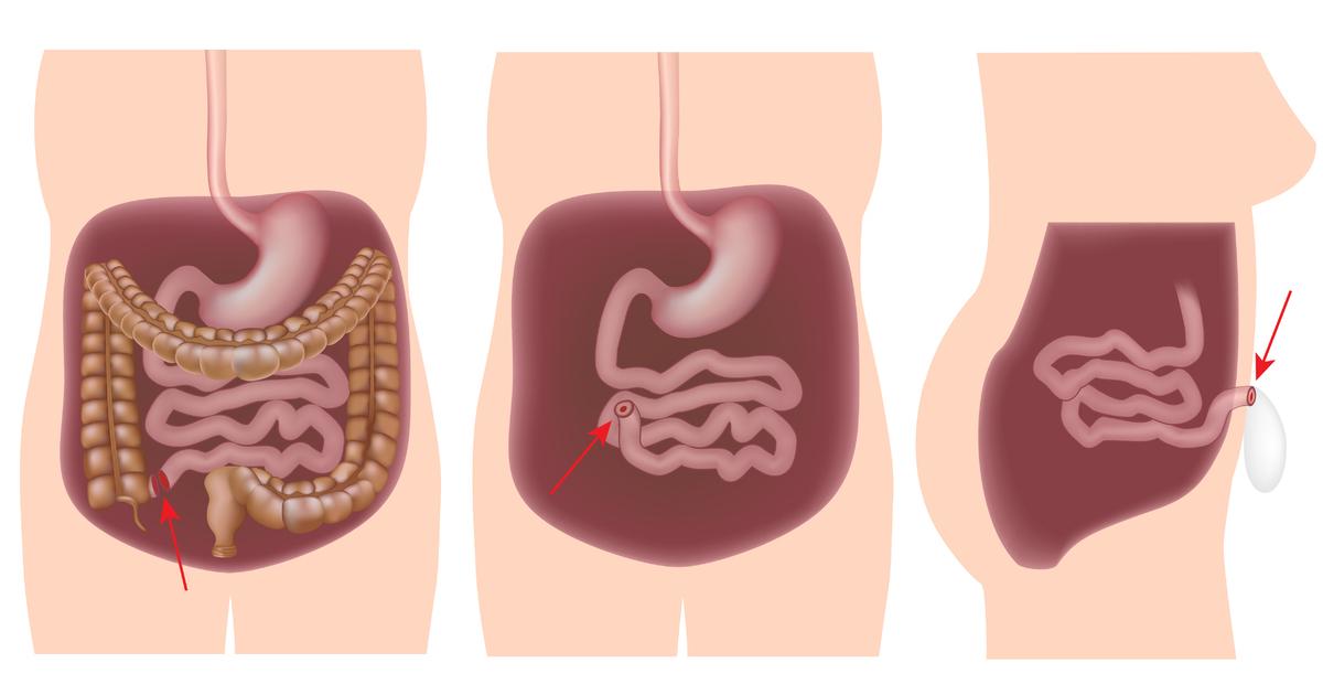 How is a colectomy done?