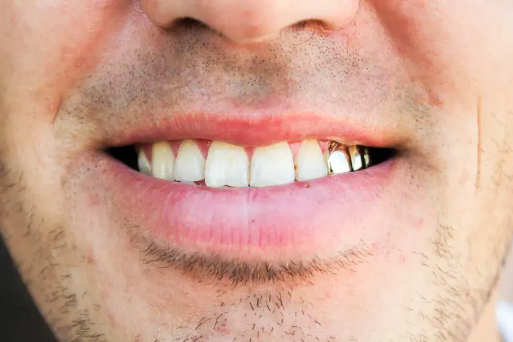 Tooth Jewelry cost in Iran 