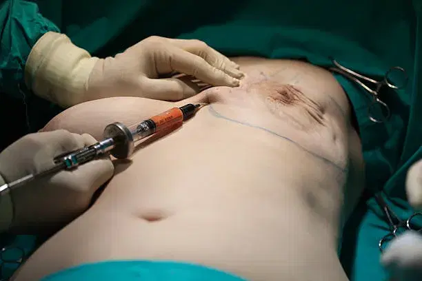 Mastectomy cost in Iran