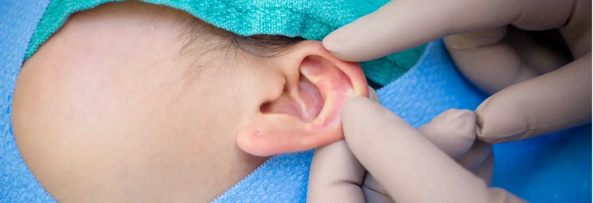 Cost of Otoplasty in Iran 