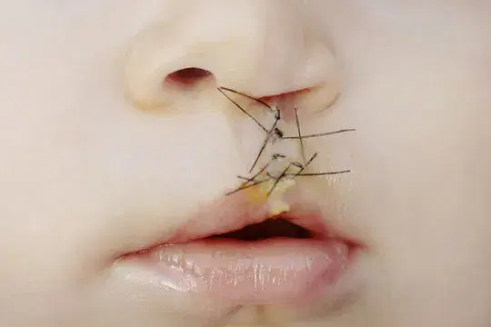 what is Cheiloplasty? 