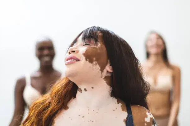 Vitiligo treatment cost in Iran