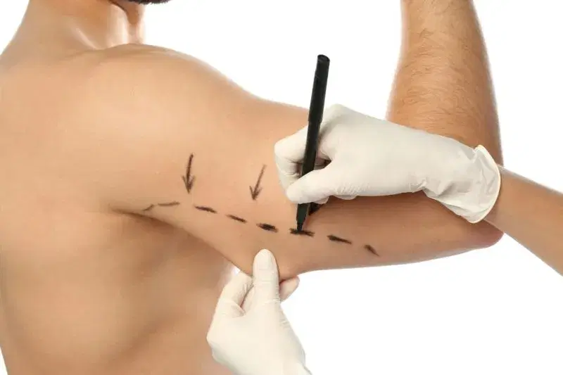 Brachioplasty Cost in Iran 