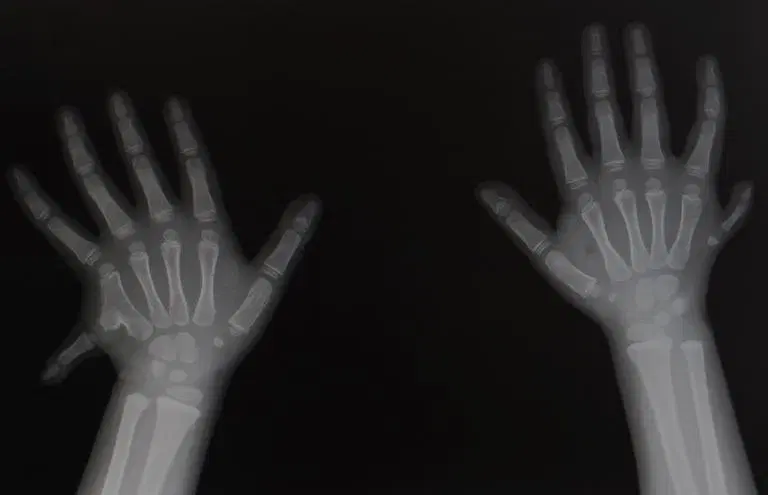 Polydactyly surgery cost in Iran