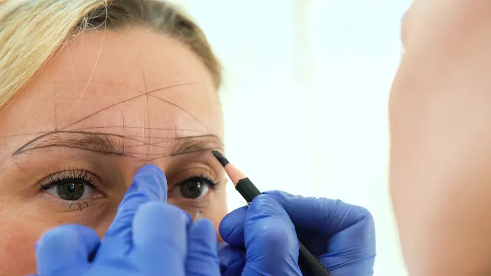 Brow Transplant Cost in Iran