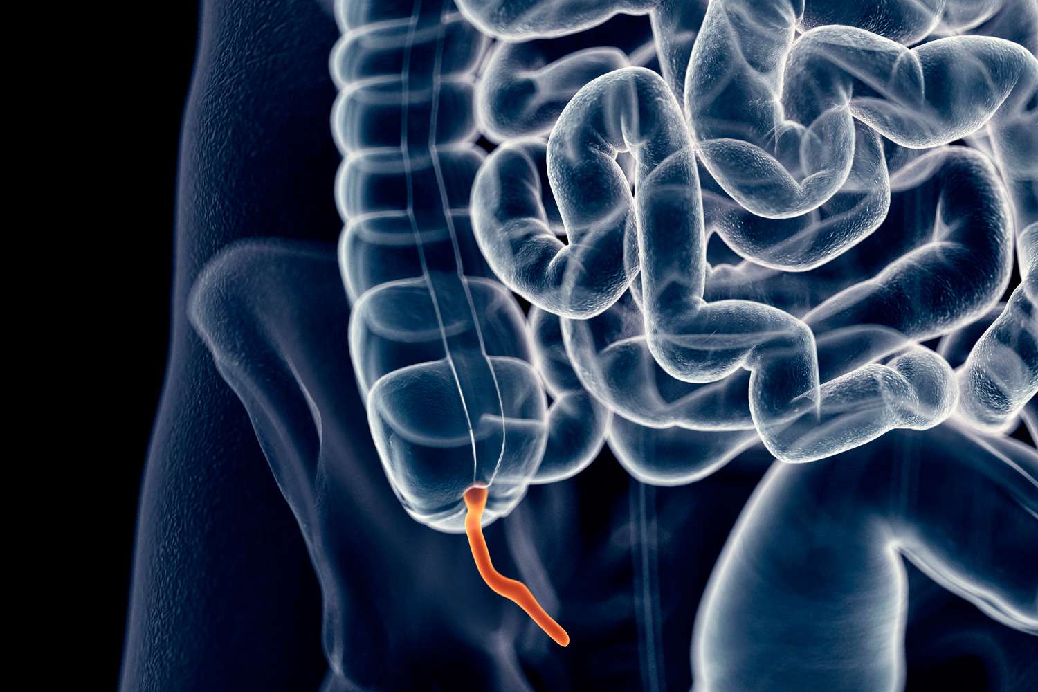 What is an appendix removal surgery?