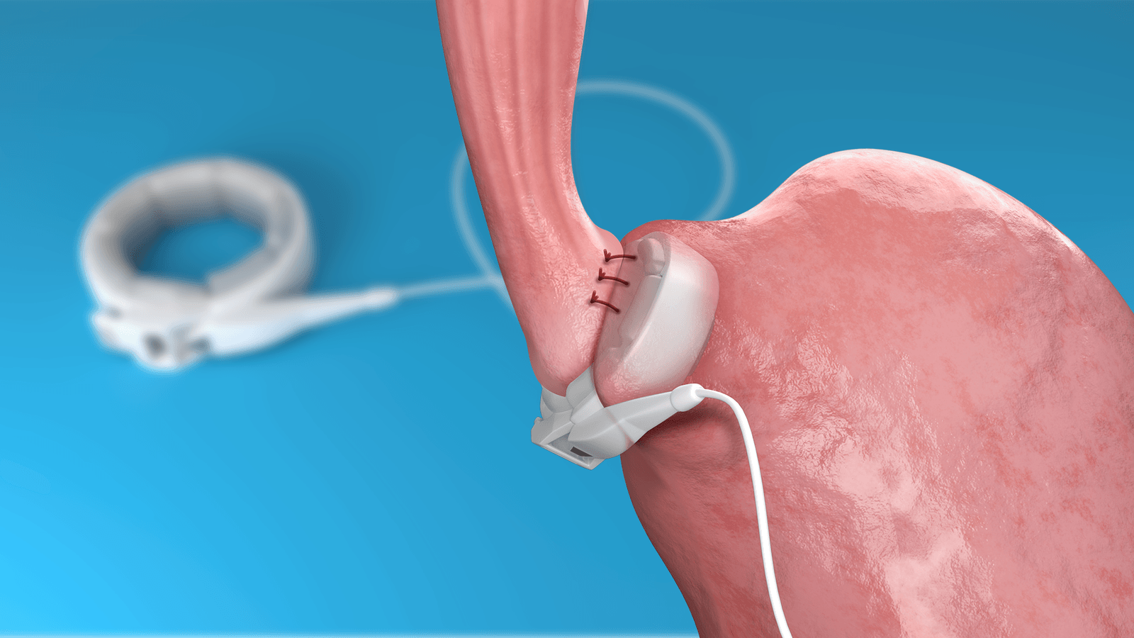 What is a Gastrectomy?
