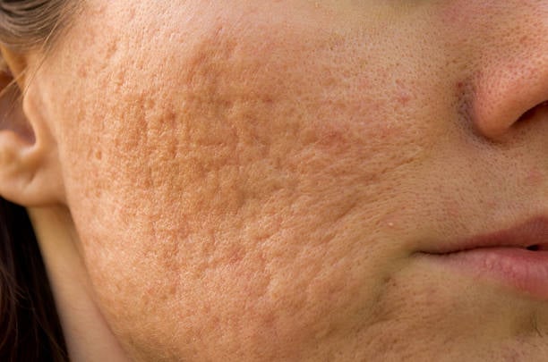 What is Acne?