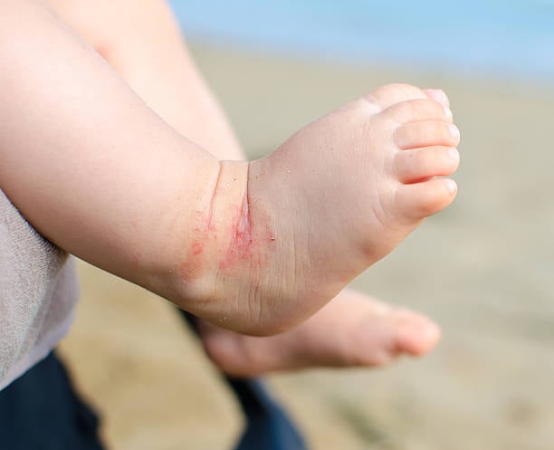 How is Eczema Treated?