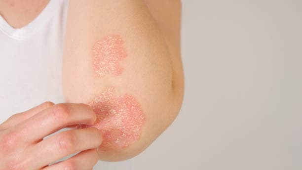 Can eczema be prevented?