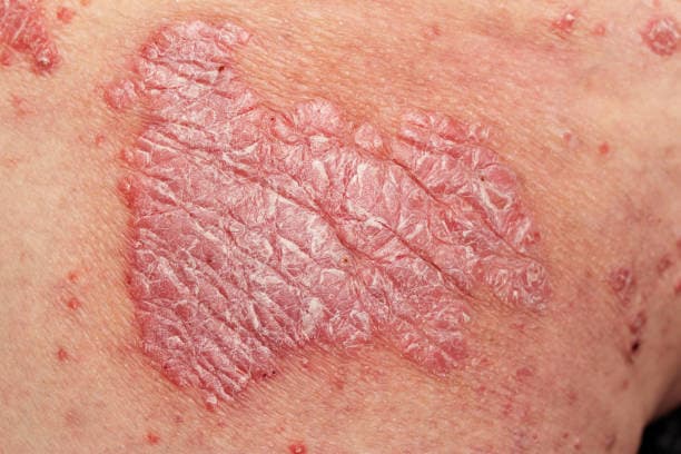 What are the types of Psoriasis?
