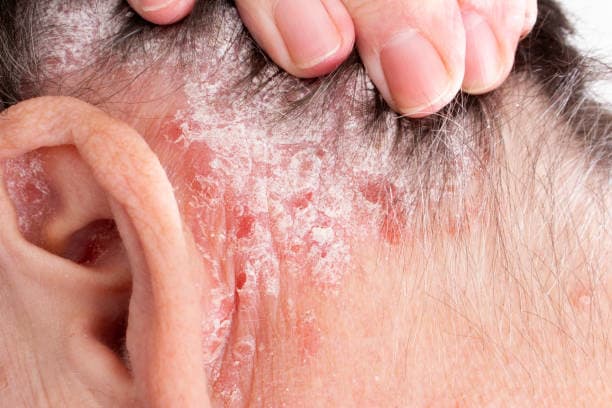 How is Psoriasis treated?